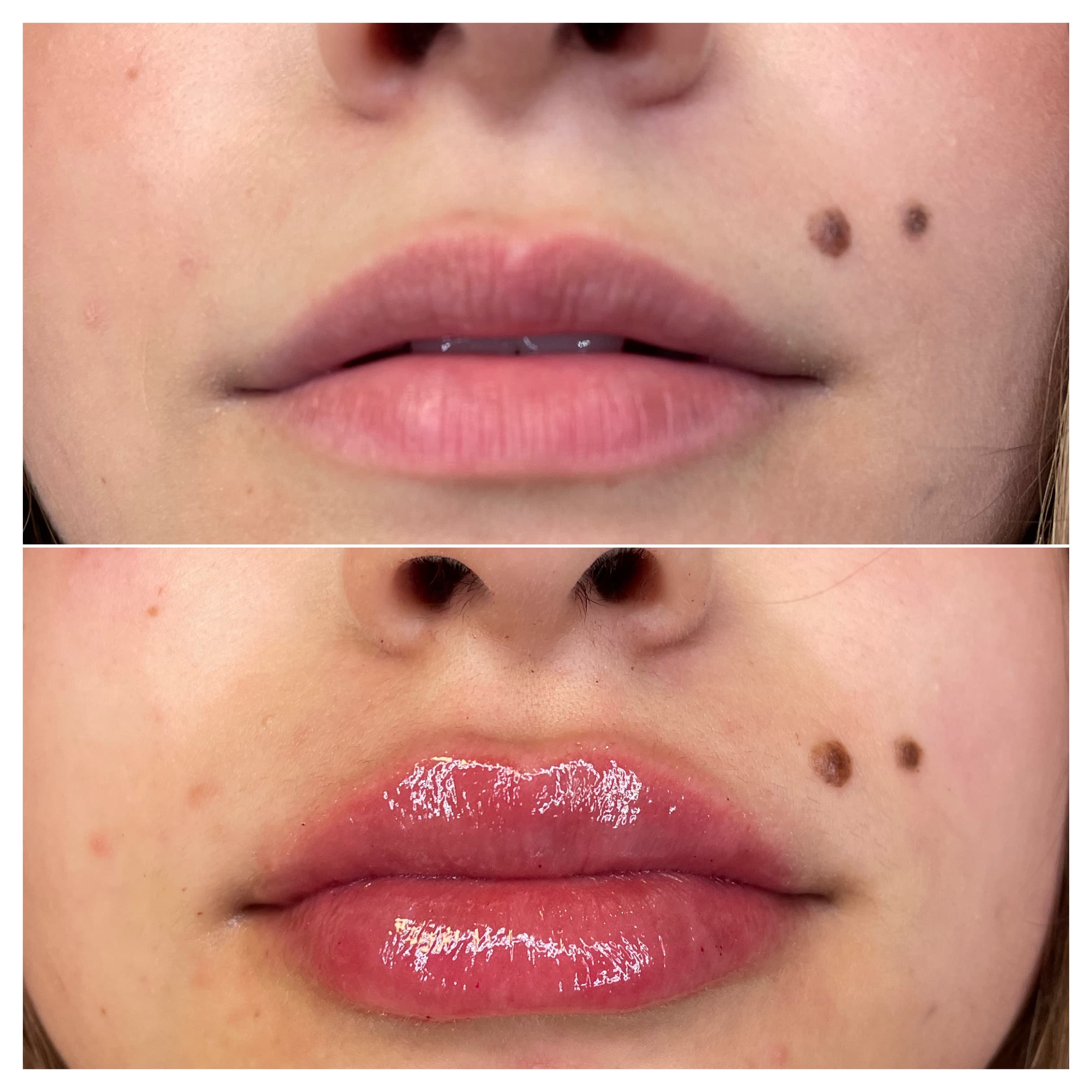 Preenchimento Labial